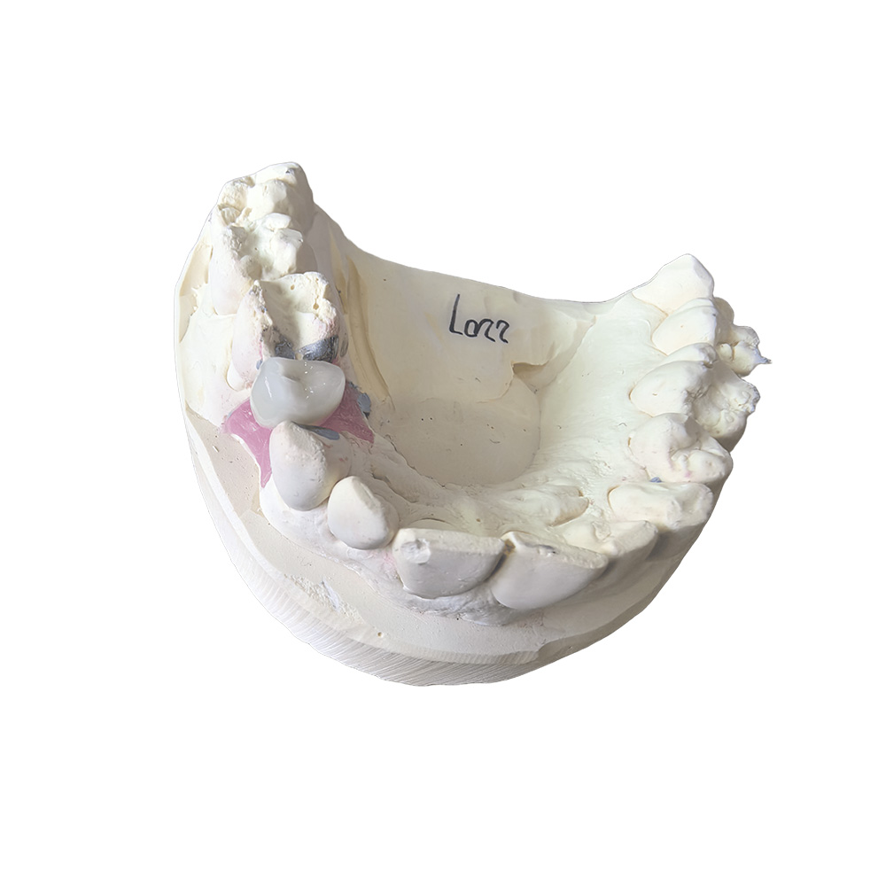 A1 Zirconia Crowns
