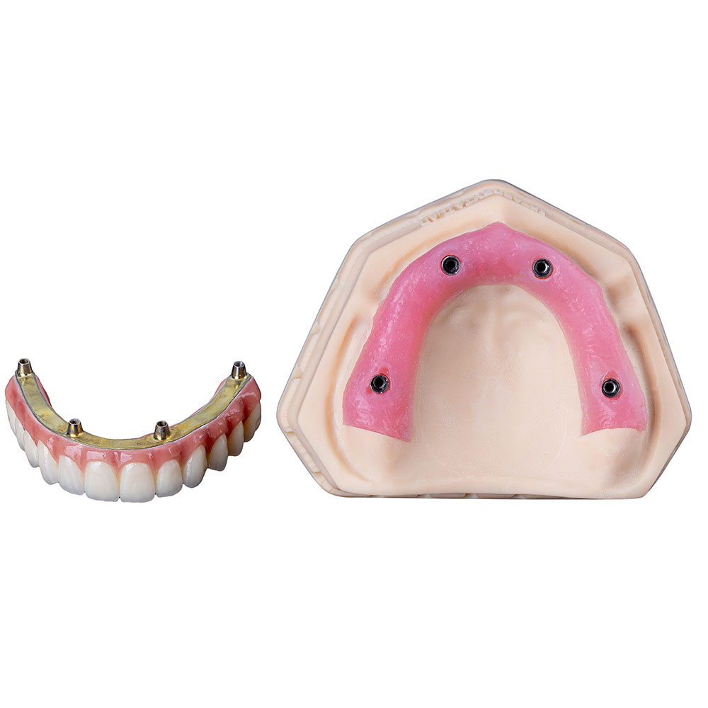 All On 4 Dental Implants