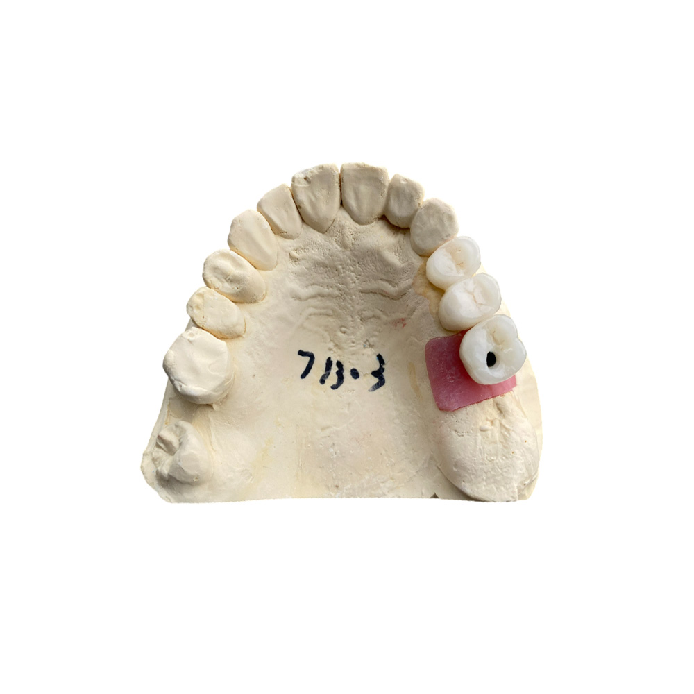 B1 Zirconia Crowns