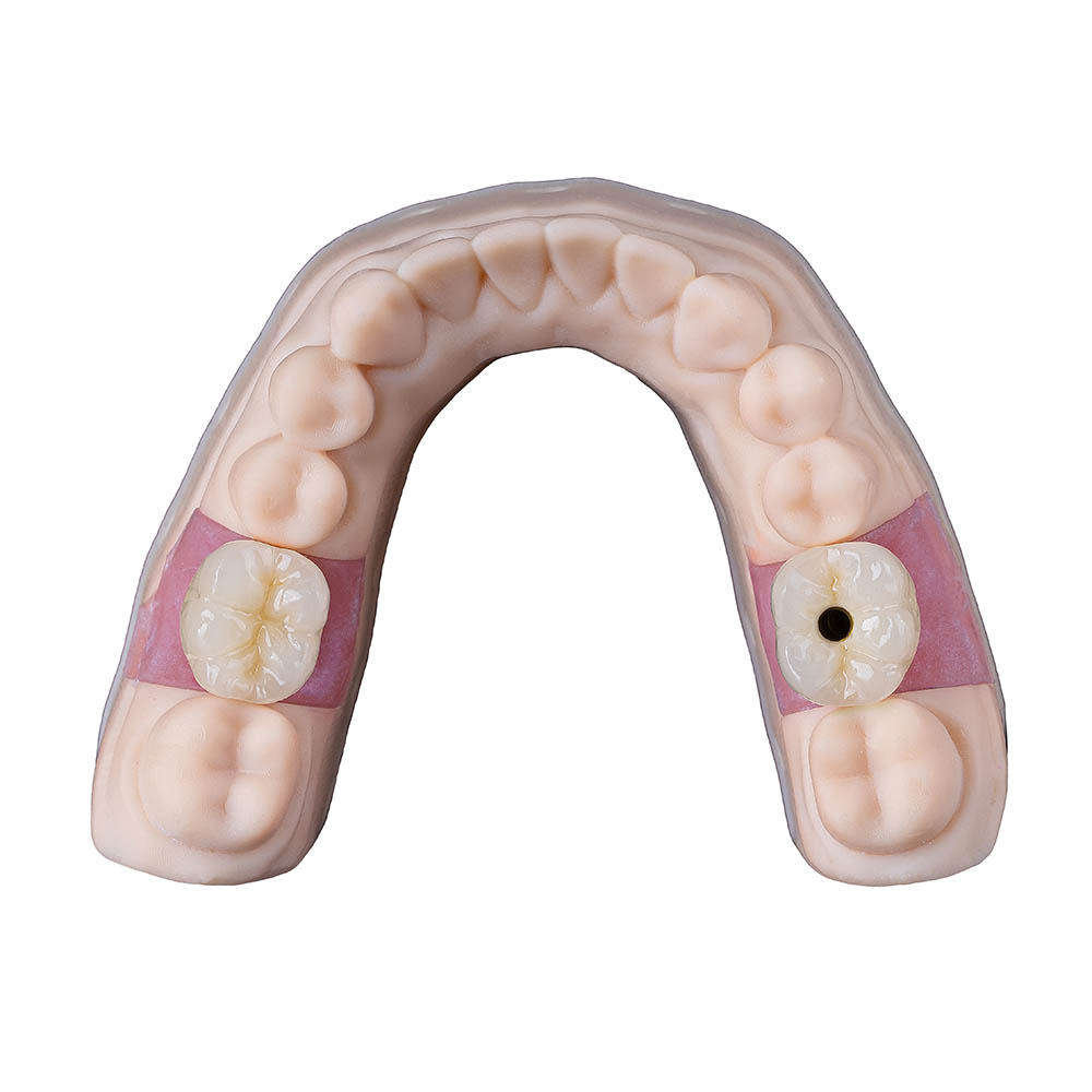 Cement Retained Implant Crown
