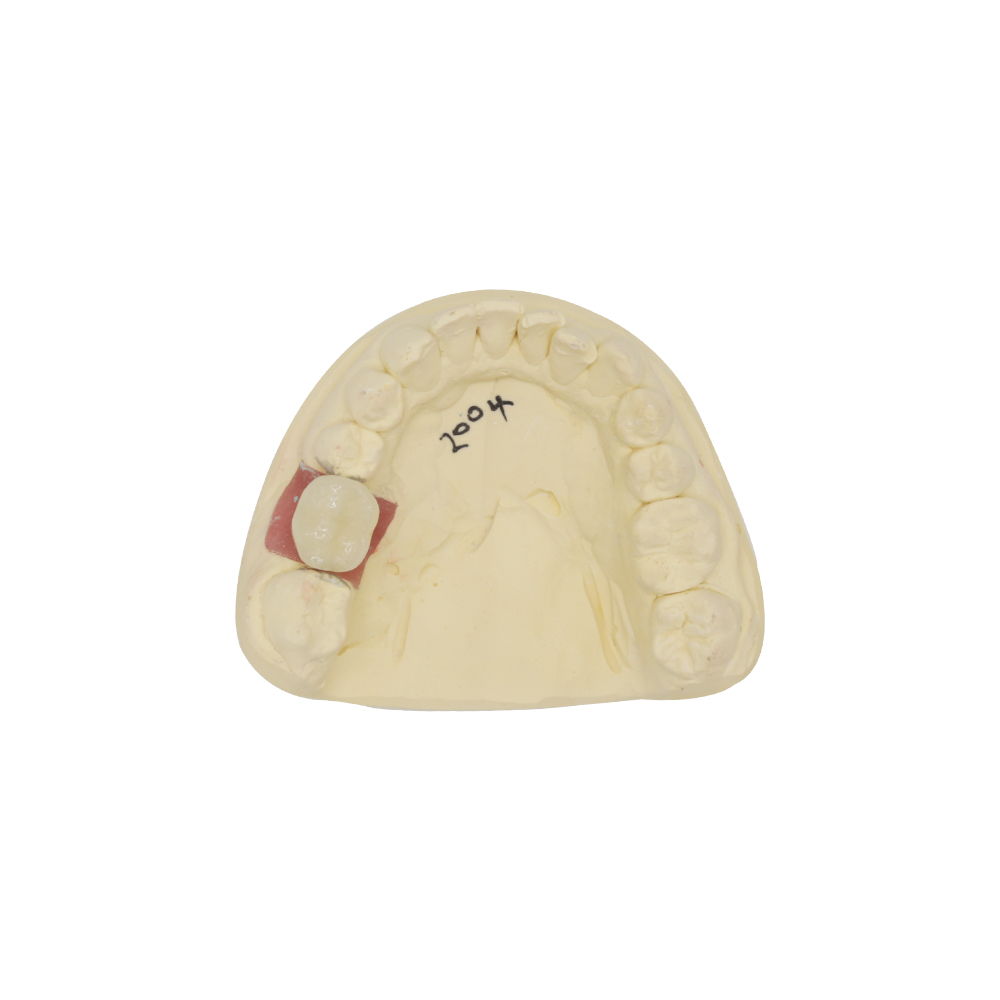 Cement Retained Implant Crown - case 2