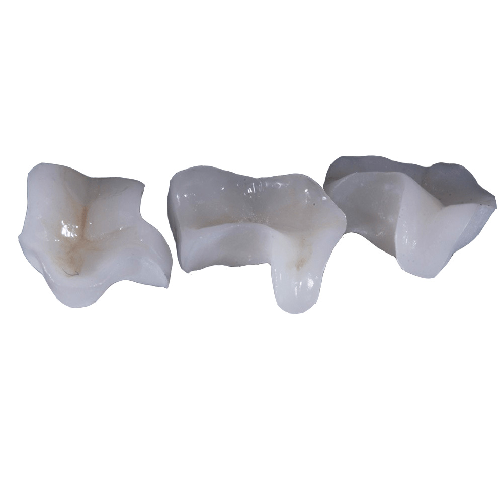 Ceramic Porcelain Inlays And Onlays - case 2