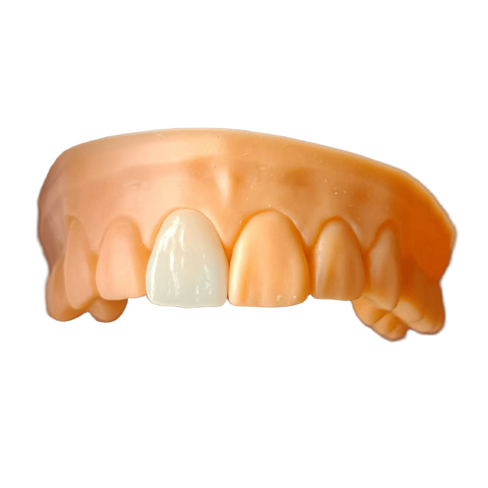 Ceramic Veneers - case 2