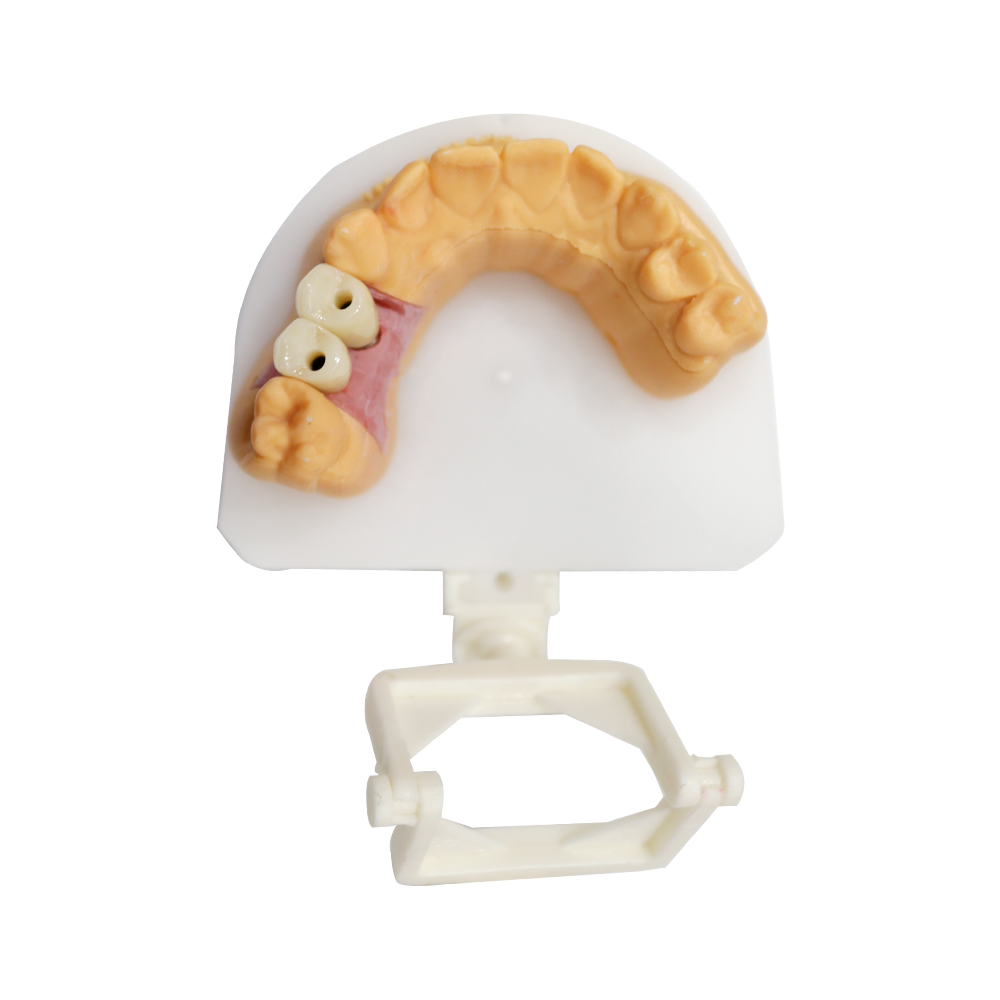 Dental Implant Prosthetics - case 3