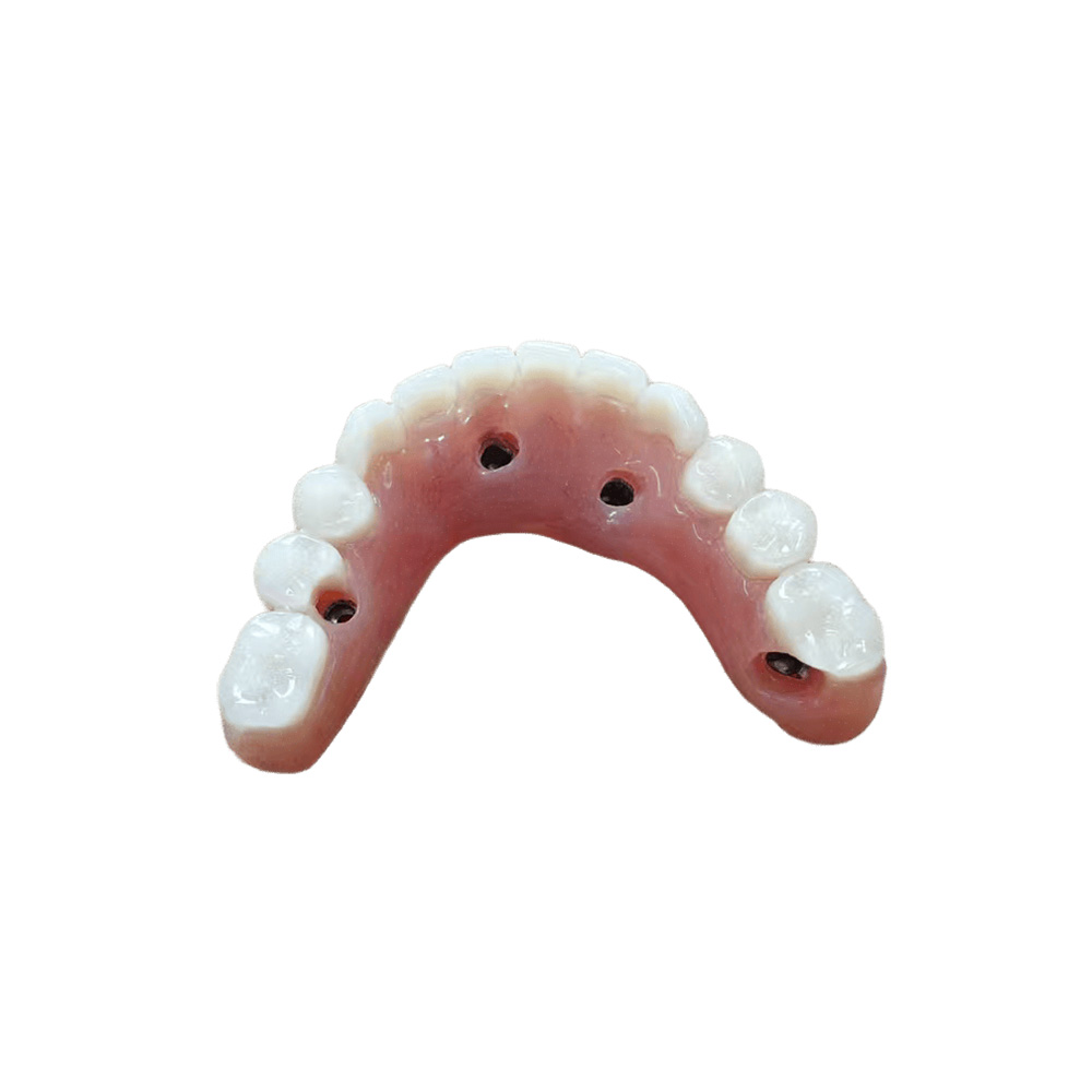 Fixed Permanent Implant Supported Dentures - case 2