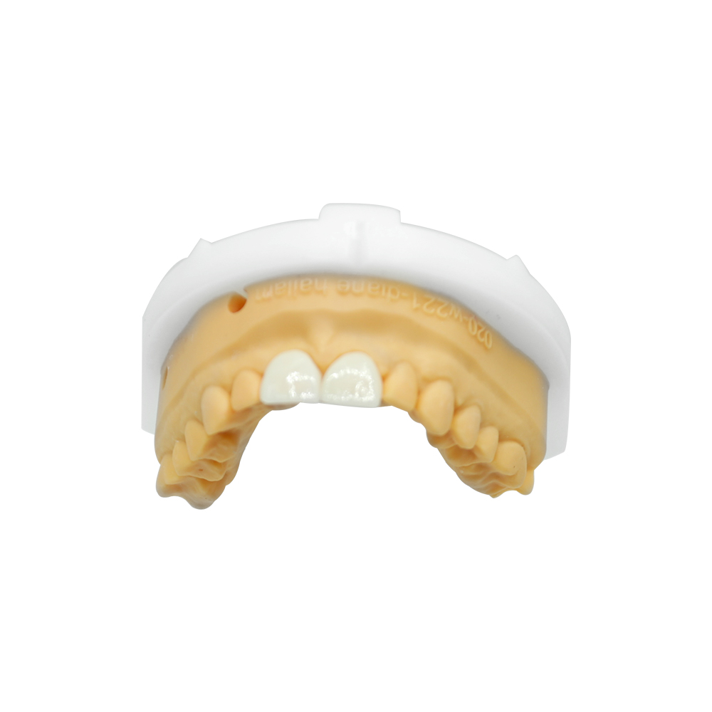 Front Anterior Teeth Veneers - case 3
