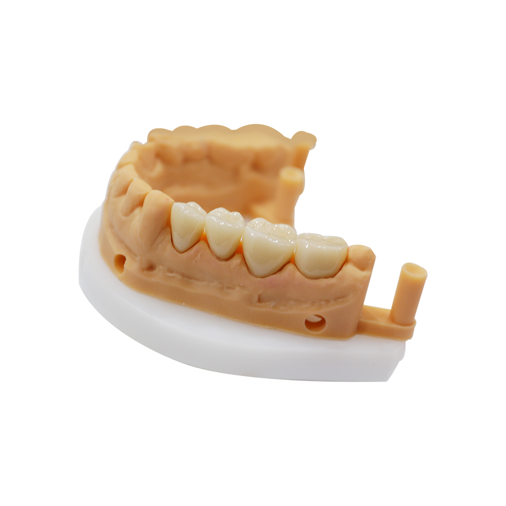 Zirconia Restorations - produced by Istar Dental Lab