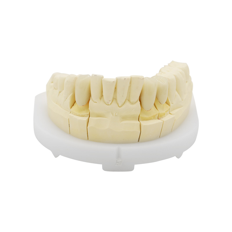 Full Contour Zirconia Crown and Bridge - case 2