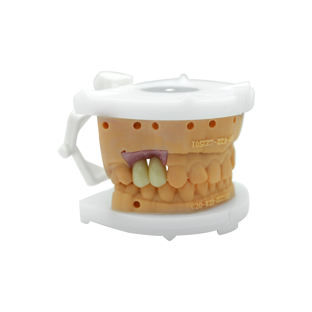 Multiple Dental Implants