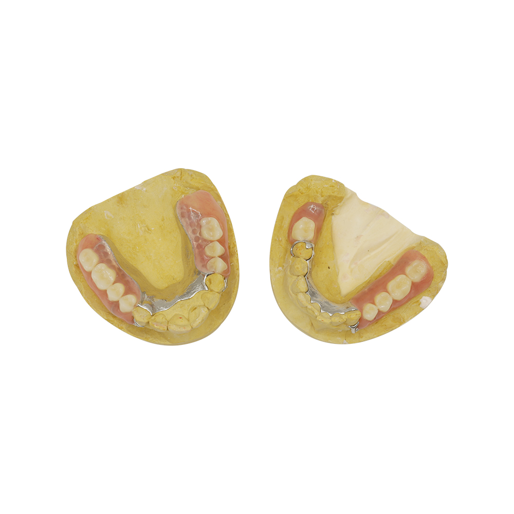 Partial Metal Dentures with Clasps