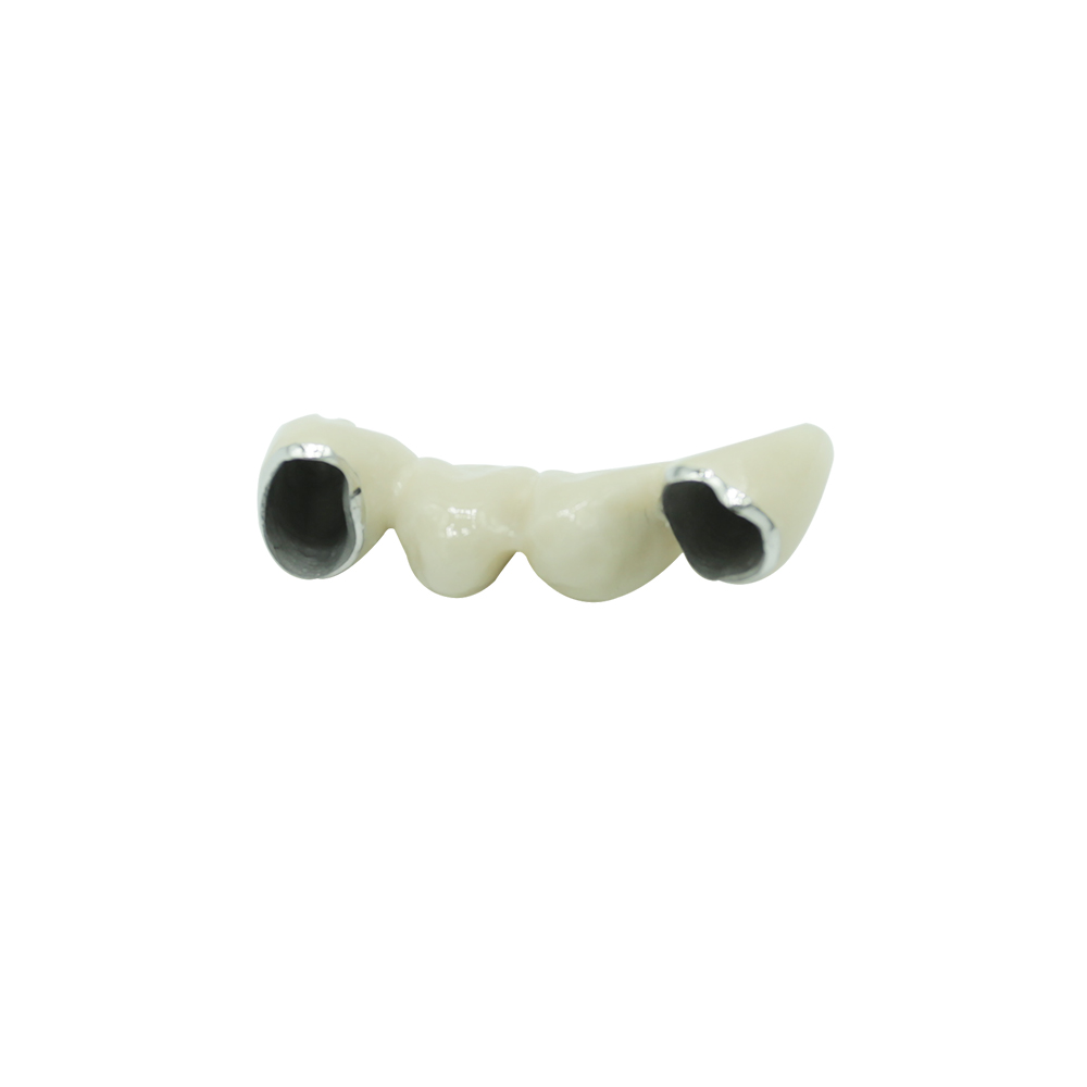 PFM Bridge Anterior