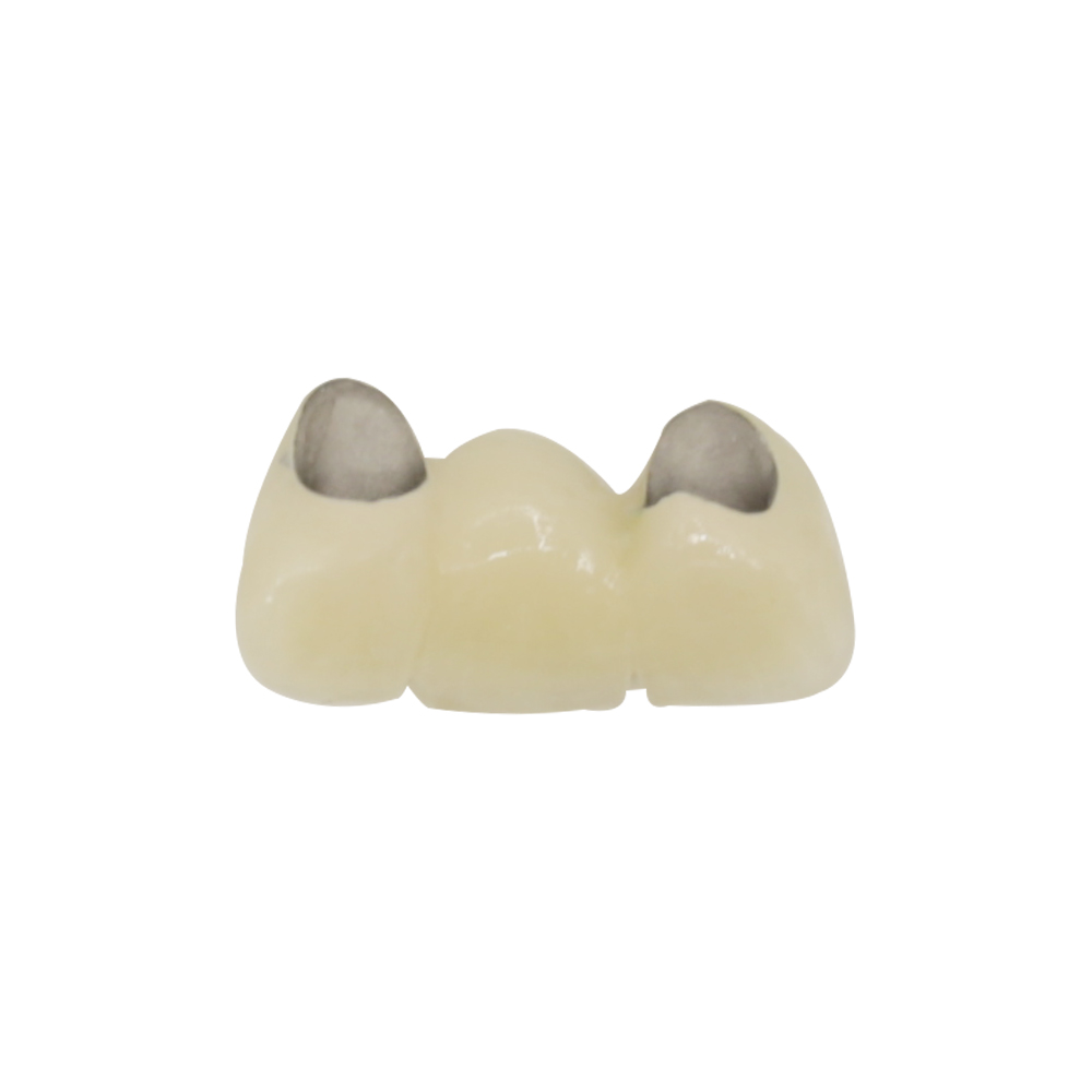 PFM Bridge Anterior - case 2
