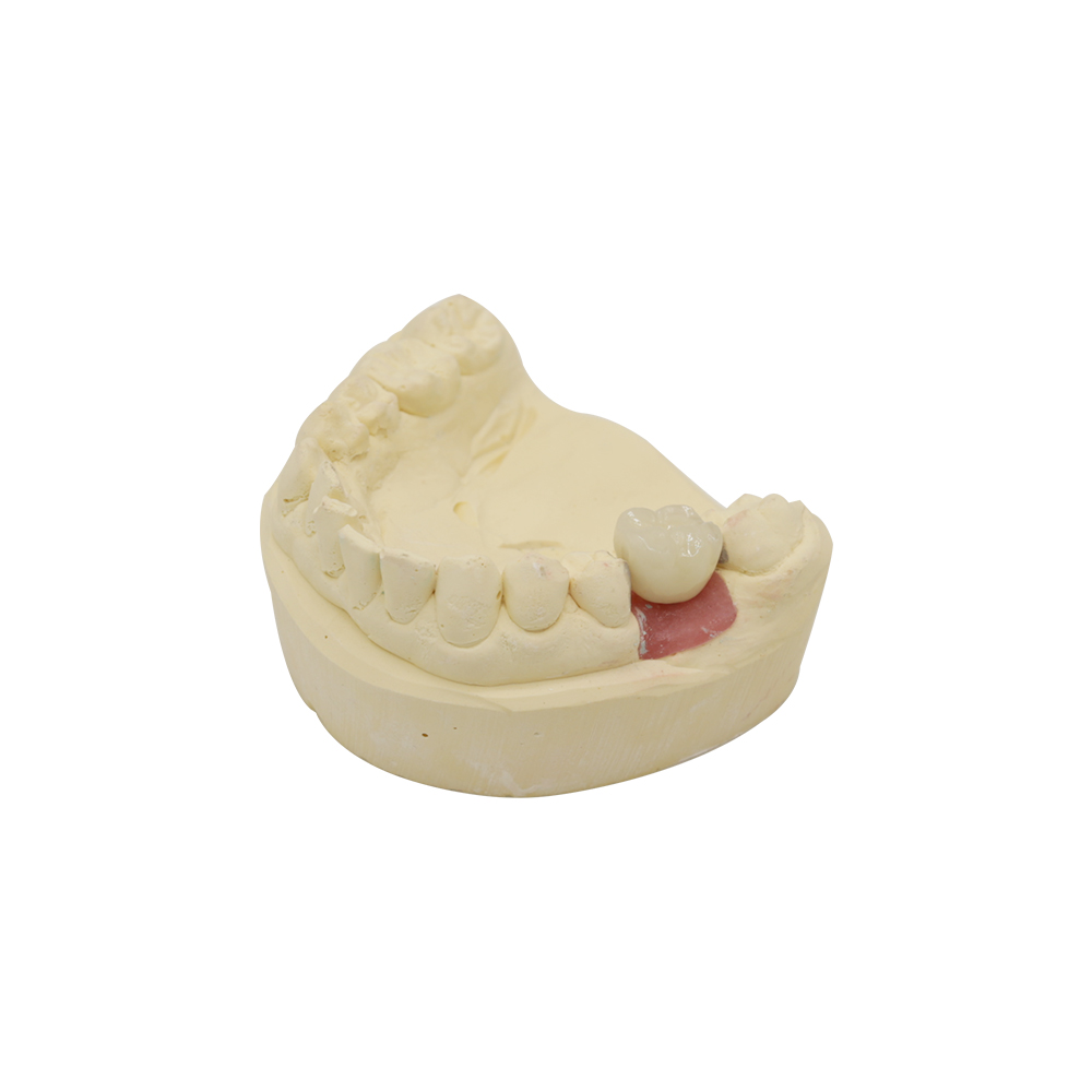 PFM Implant Crown - case 2