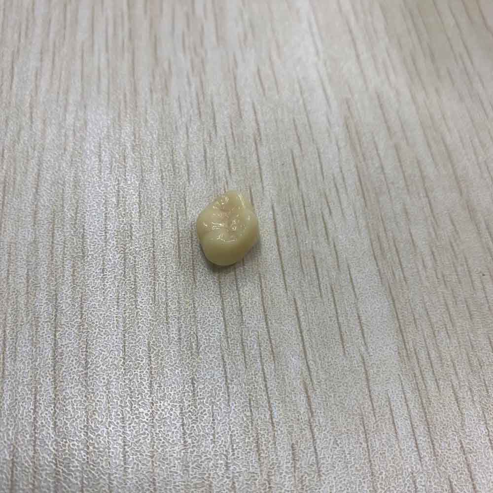 Temporary Lower Teeth - case 2