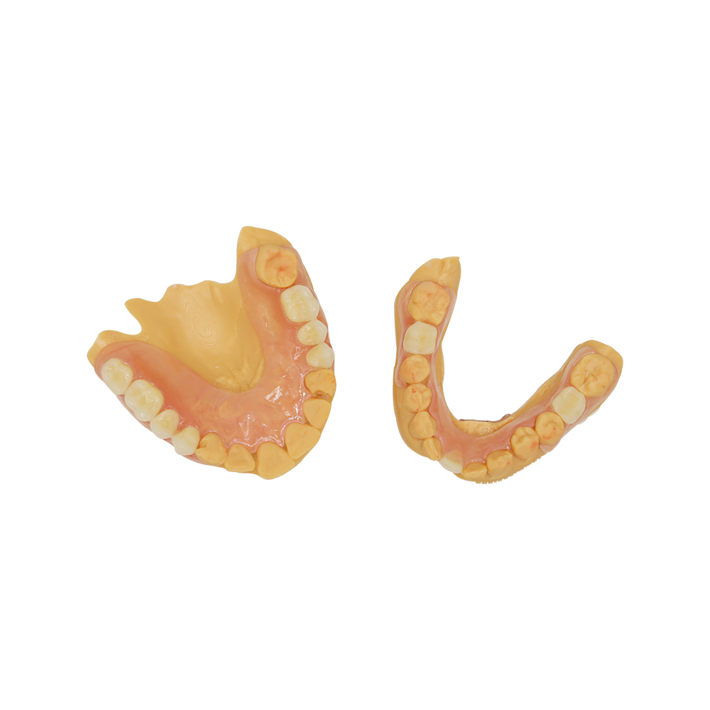 Valplast Bridge Denture - case 2
