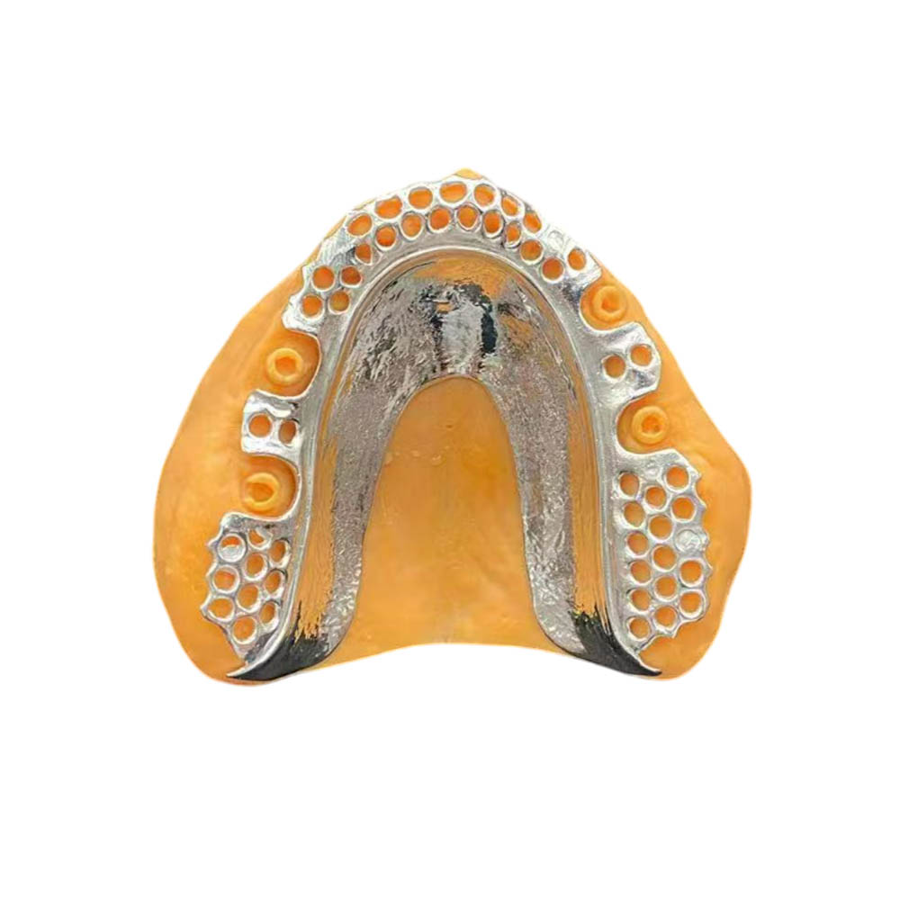 Vitallium Partial Denture - case 2