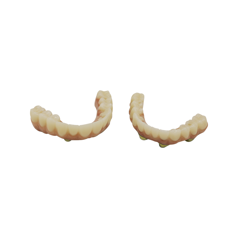 Zirconia Screw Retained Implant Crown - case 2